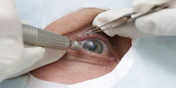 Cataract Services